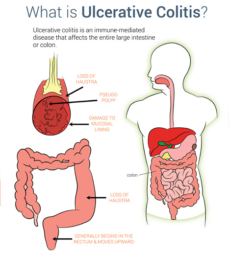 ulcerative colitis 